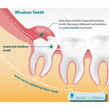 Teeth no pain wisdom Healthboards