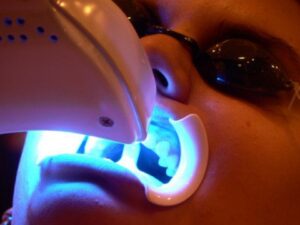 teeth-whitening-1